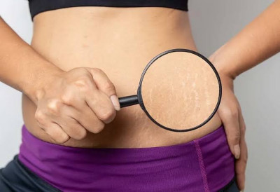 External application of clarified butter can prevent pregnancy stretch marks