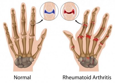 Study finds Ayurvedic Whole System (AWS) can reverse Rheumatoid Arthritis symptoms 