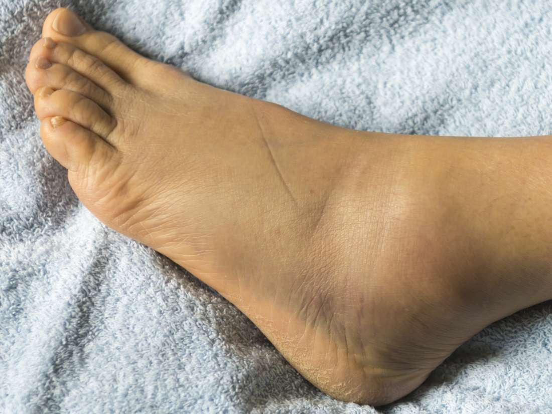 Remedy for swelling on foot